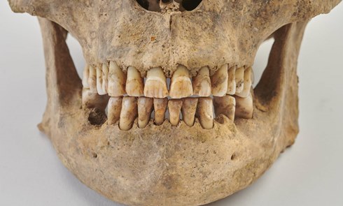 Teeth of a male from the medieval period, coming from the excavations of St Mary Spital, Augustinian Priory, during development of the Spitalfields Market. (ID no.: SRP98 [3779])