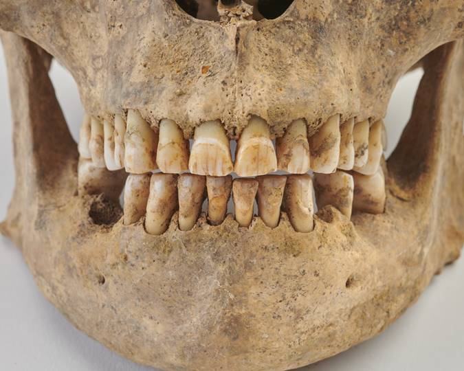 Dentition Medieval Spitalfields, dental history, 19th century dentistry