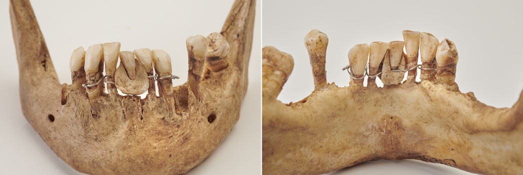 Mandible of Charlotte Bampton Taylor with a ‘Waterloo tooth’. (ID no.: MAL92 [27])