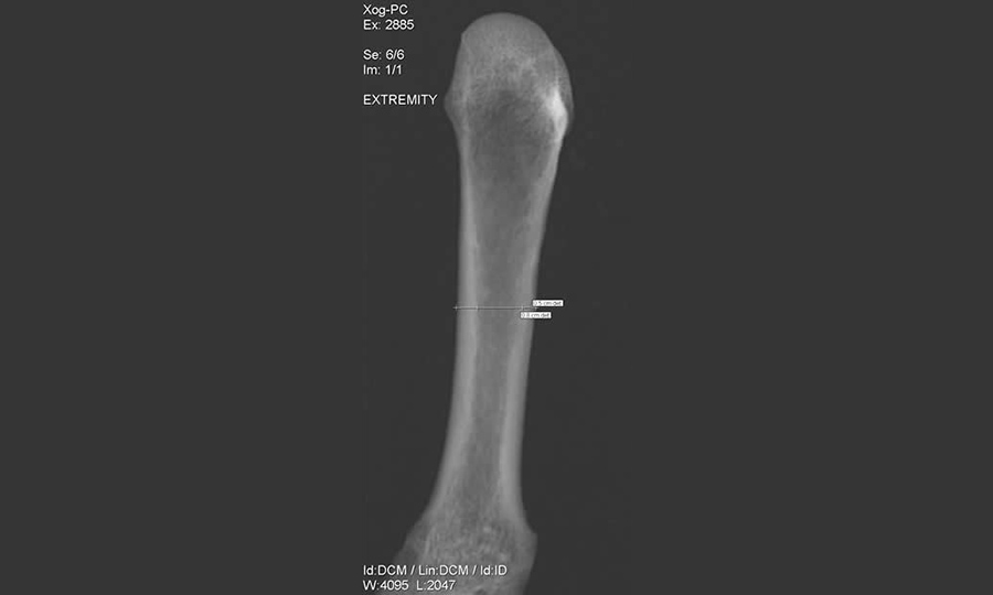 Figure 184 Left 2nd metacarpal showing the measurements for the Cortical Width (longer line, 0.8cm) and the Medullary Width (shorter line, 0.5cm) old adult female, Industrial London (SB79 97)