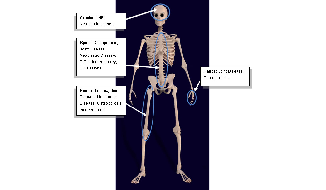 A 3D model of a male skeleton annotated with diseases relating to industrialisation.