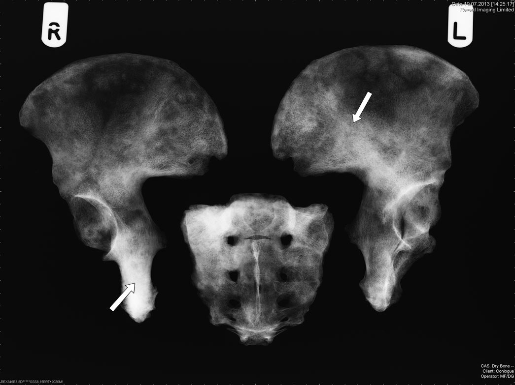 Digital radiograph of pelves and sacrum showing mixed lesions of lucency and sclerosis indicative of metastatic bone changes, old adult male, Industrial London 