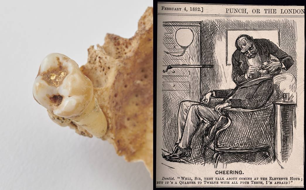 (left) Male with gold filling of right first maxillary molar, upper jaw (ID no.: FAO90 [1716]), and (right) a dentist examining a patients teeth and informing him they are all in exceedingly bad condition. Wood engraving by G. Du Maurier, 1882. (Courtesy: Wellcom Collection/Public domain)