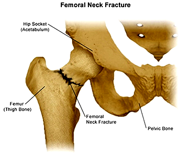 industrialisation_182 Femoral neck fracture (Credit © Stanford Health Care,httpsstanfordhealthcare.orgmedical-conditionsbones-joints-and-muscleship-fracturetypes.html.png